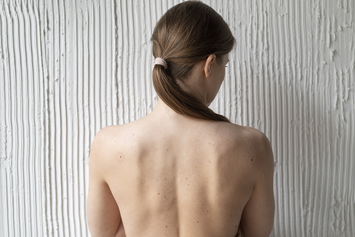 Mujer de espalda melanoma piel