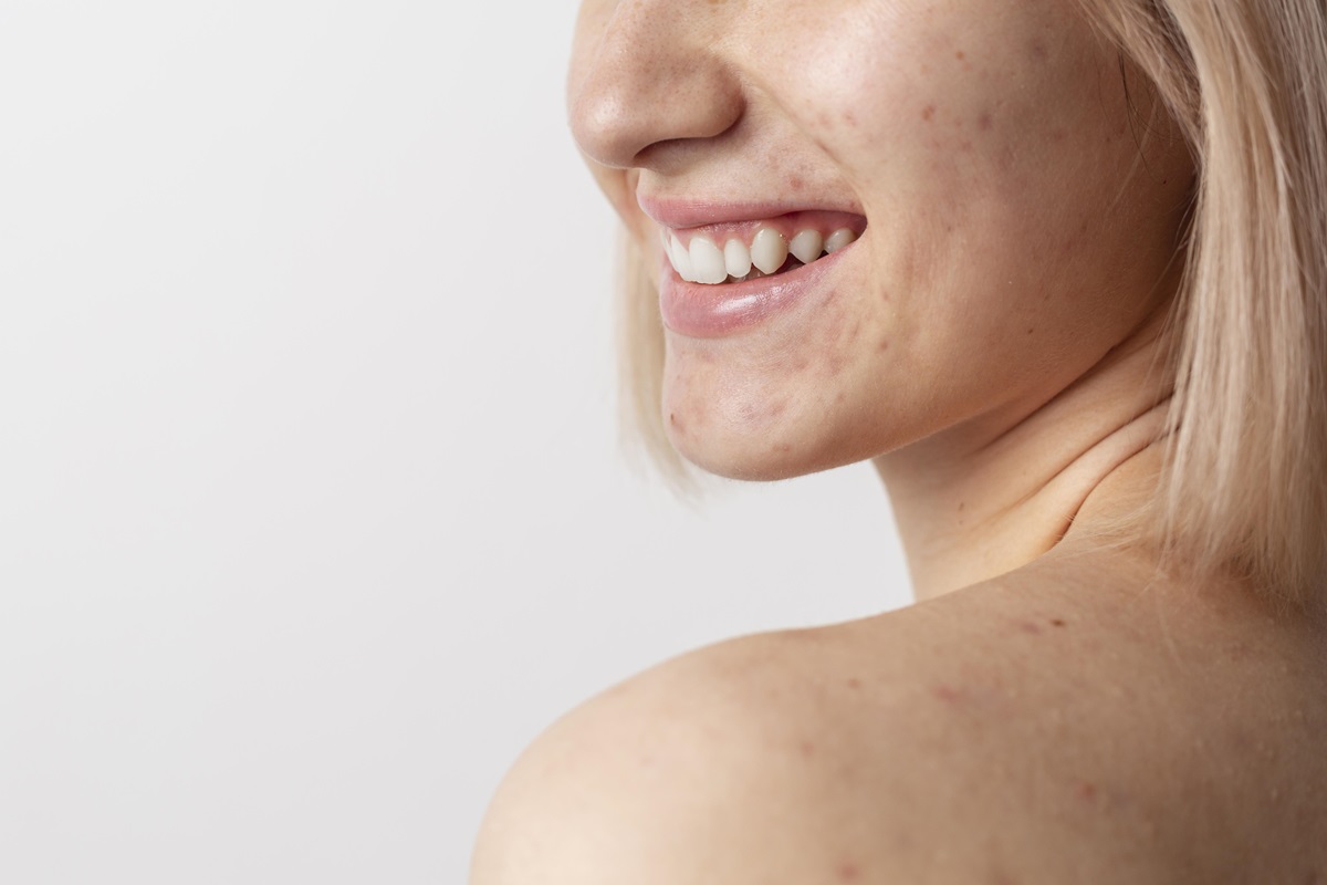 acne granitos barritos espinillas cara cuello espalda